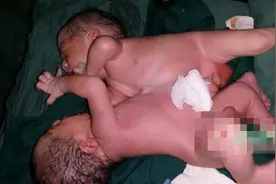 18岁孕妇诞连体双胞胎 三成连体婴仅能活一天图片