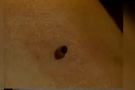 直接灸的详细操作步骤以及艾灸时、化脓后的注意事项