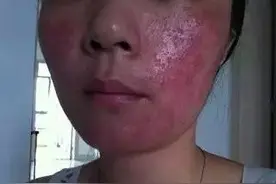 激素脸是什么？有什么特征？图片