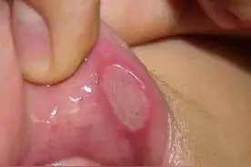 口腔溃疡一次治愈！太神奇了~~~图片