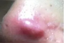 姐妹们如何处理脓包型痘痘，恶心也要看完图片
