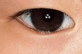 孩子眼红眼痒眼屎多、有眨眼…都是“结膜炎”？眼科门诊最常见的眼病也有大学问！图片