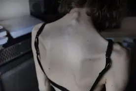 法研究:厌食症病因竟为减重上瘾 而非惧怕肥胖图片