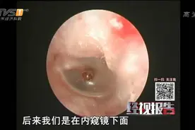 蟑螂爬进女子体内 强掏差点穿耳膜