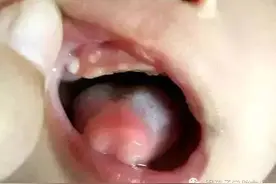 4周大的宝宝嘴里长黄白色疙瘩是啥病？能不能用针给孩子挑掉？图片