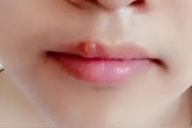 嘴唇上火长泡,变成黑印怎么办？学会自己去火，去黑印图片