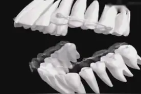 动画演示牙齿矫正全过程，门牙前凸是如何慢慢达到内收效果的！