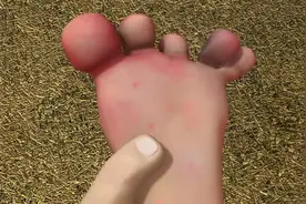 熊出没，光头强的鞋子真臭，脚丫还出血了，呜呜，又红又肿！视频封面