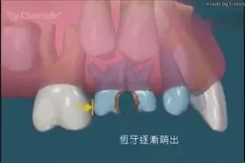 乳牙时整整齐齐，怎么换牙后牙齿不整齐了？