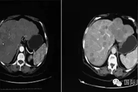 肝脏多发占位性病变1例图片