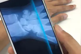 手机就可以拍X光照，来看看自己的手指骨骼视频封面