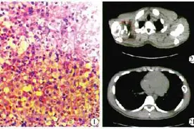 病例：难治性骨嗜酸细胞肉芽肿一例图片