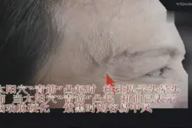 头部青筋与疾病视频封面
