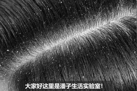 顽固头皮屑洗不净，试试这方法，不仅去屑效果好，还能止痒！视频封面