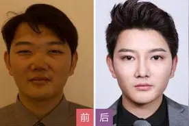 烟台割双眼皮适合哪些人？图片