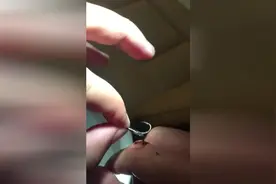 钓鱼不成被鱼钩刺穿手指，医生这般取出来。看着就疼阿图片