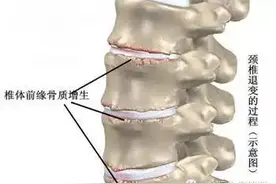 颈椎骨质增生该如何治疗才最好图片