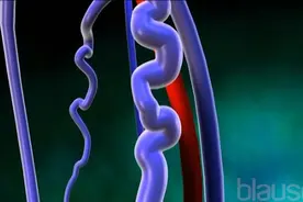 医学3D动画演示：什么是静脉曲张？静脉曲张的这些常见病因要注意视频封面