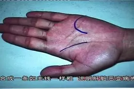 中医诊断-手诊-手掌信息看健康-肝硬化，您看准吗？视频封面