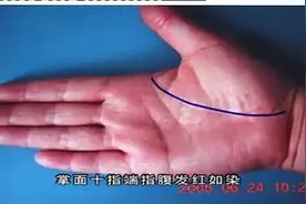 中医诊断-手诊-手掌信息看健康-糖尿病早知道，您看准吗？视频封面