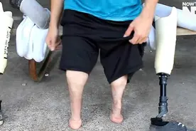 这位双腿截肢者向人们“炫耀”：不用假肢，他也能走路视频封面