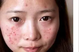 痘痘到底应该怎么去消除，你真的知道吗？图片