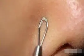 痘痘、粉刺你还敢挤吗？图片