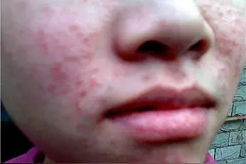 痘痘粉刺里面挤出来的白色东西是什么，怎么解决？图片