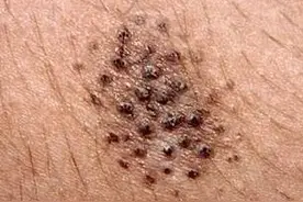 痘痘、粉刺怎么出现的？如何治疗痘痘粉刺？图片