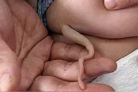 女婴生来带尾巴 专家称或为返祖现象图片