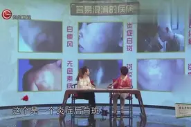 并不是所有白斑都是白癜风，容易混淆的白色斑点全讲解视频封面