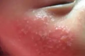 小儿奶藓怎么办？图片
