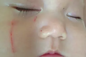 心疼！宝宝的脸被自己抓成这样了！图片
