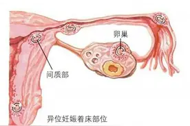 今日剖析！输卵管间质部妊娠超声表现图片