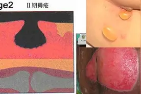 褥疮的护理和治疗图片