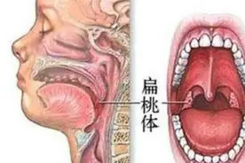 扁桃体肿大到底要不要手术切除？