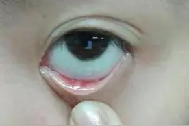 之前经常长针眼来分享一下经验图片