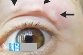 女子脸上肿块会移动，医生发现原因！视频封面