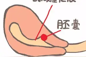妇幼专家提示二胎时代，瘢痕妊娠不容忽视图片
