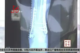 骨折做手术 钢板竟然暴露在外视频封面