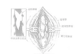 椎管内肿瘤患者的术后需注意哪些？图片