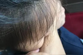 邓超胳膊被小花妹妹咬出深深两道牙印，咬完中毒晕倒？自叹太感人图片