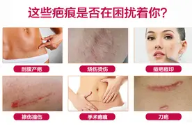 祛疤产品你了解吗？Rosa祛疤膏与Dermatix疤痕膏对比图片