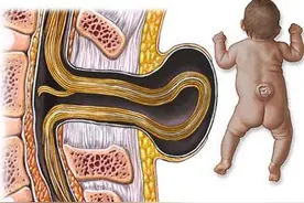 脊柱裂患者的常见临床表现有哪些？图片