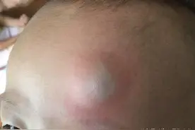 宝宝脑袋摔了，被奶奶揉出了一个大包，结果成这样了！图片