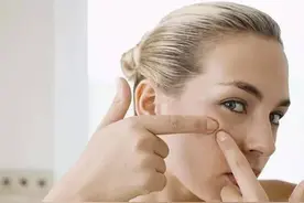 夏季上火长痘痘 怎么办？10招教你来应对！图片