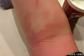 一喝酒就起酒疹，越挠越痒！是身体健康出了问题吗？医生建议、、图片