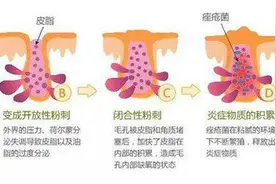 痘痘你又知道多少图片