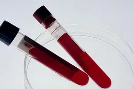 艾滋病的血液检测方法是什么图片