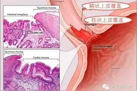 食管的巴雷特改变这么常见，它会癌变吗图片